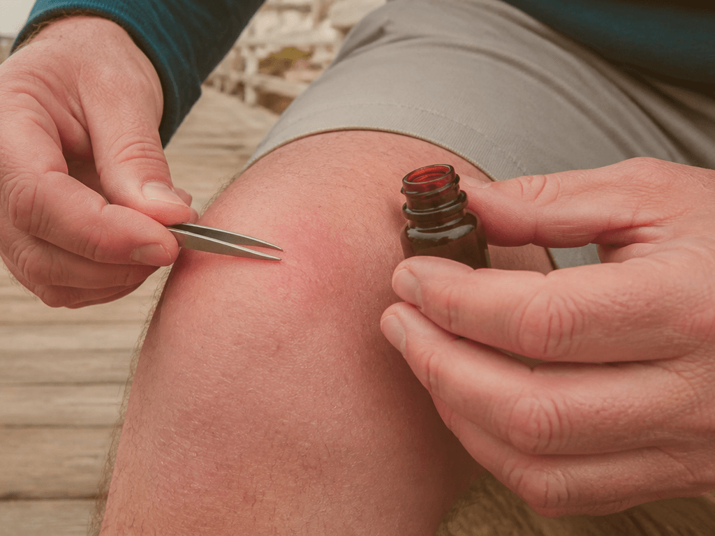 Splinter tweezers in the condo kit: boardwalk wood happens — supporting Beach Blog photo, Ocean City, Maryland